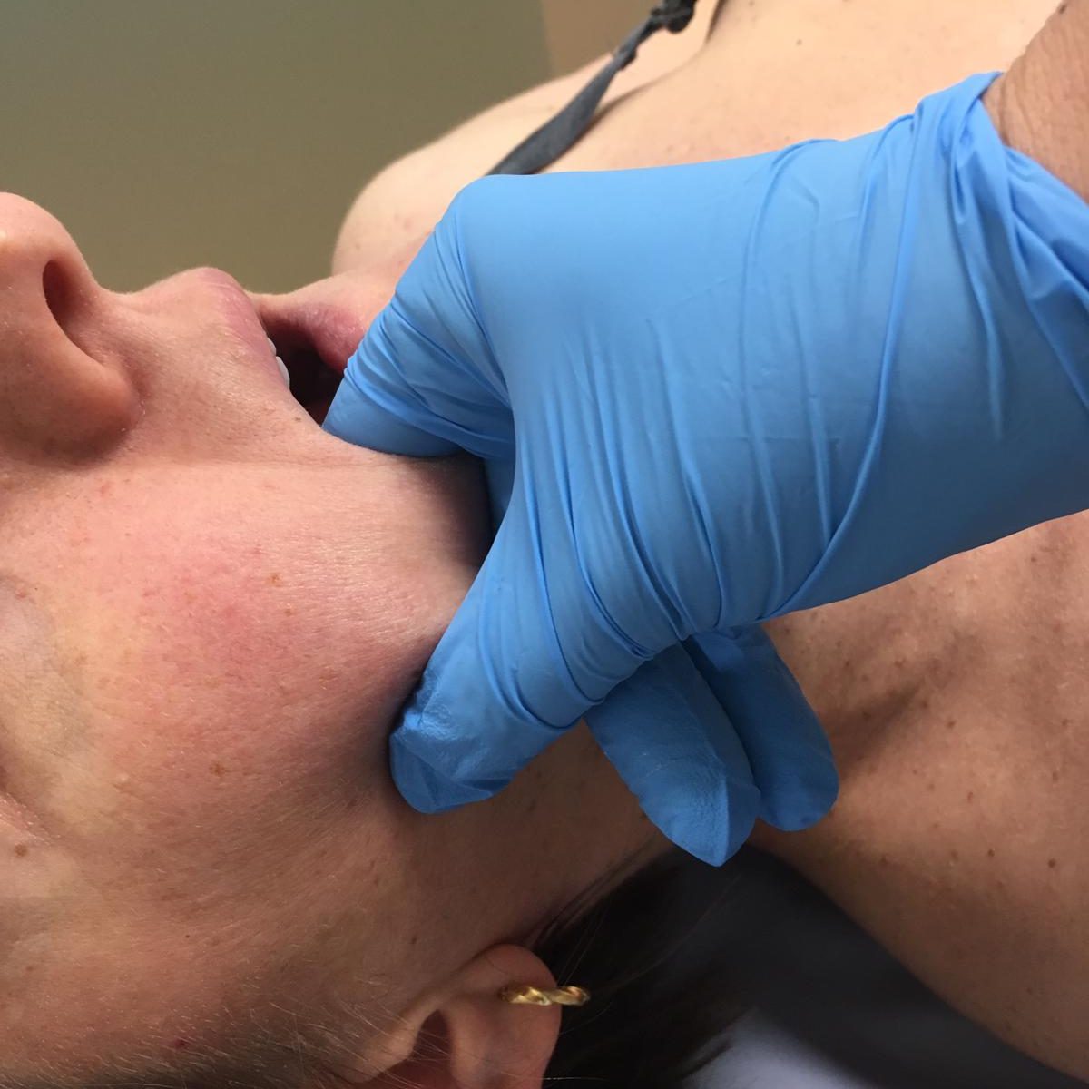 Tratamiento de la ATM Articulación Temporomandibular en REVIVE Fisioterapia